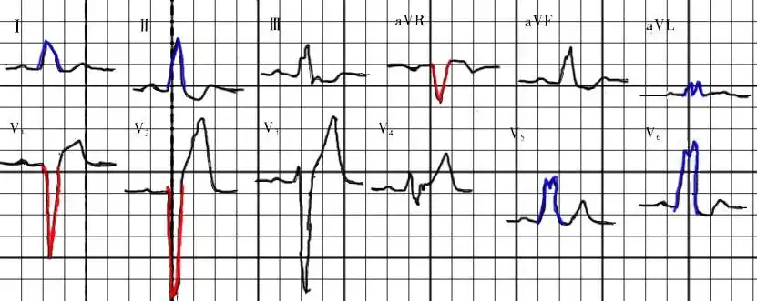 完全左束支传导阻滞
