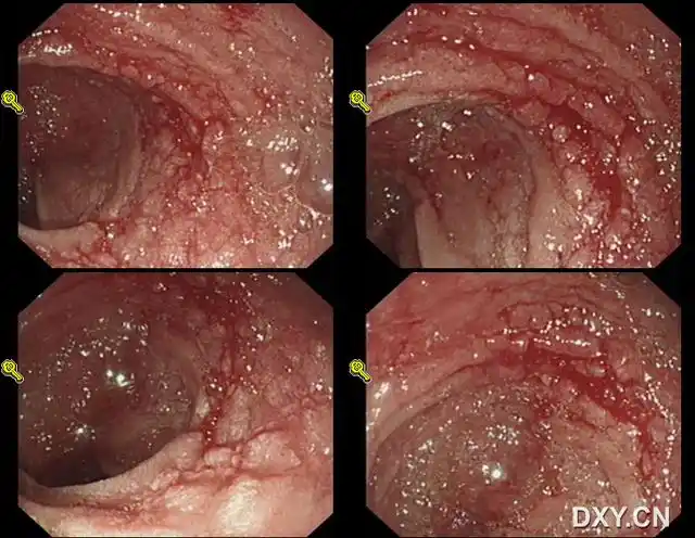 难得一见的胃镜涂片慢性溃疡