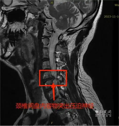 胳膊疼痛手麻乏力近两年病根儿竟是颈椎间盘突出
