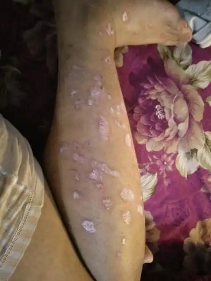 初期银屑病图片及症状图片大全_银屑病求医网