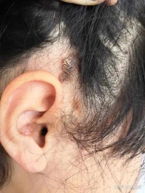 八周岁女童治疗皮脂腺痣全过程