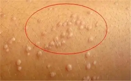 眼睑内长白色颗粒可能是汗管瘤(眼睛周围长白色颗粒的除了脂肪粒)(1)