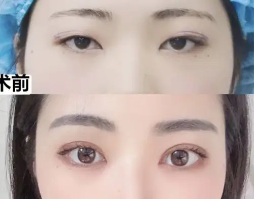 割双眼皮成功案例图片