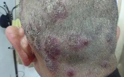 头皮牛皮肤癣传染吗图片症状有哪些表现_潍坊东方银屑病研究院_潍坊