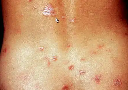 皮肤梅毒疹的病因