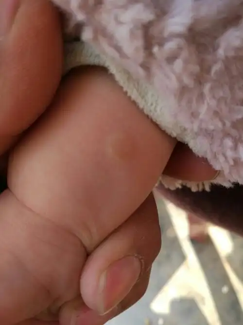 一岁半宝宝身上长黄豆大的扁平痘