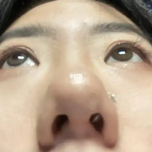 鼻头鼻翼缩小一个月～(附对比_鼻翼缩小_自拍_美颜_美妆_医美整形
