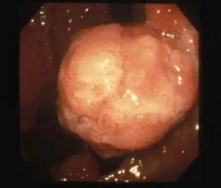 幼年性息肉病 伴有多发性胃癌的青年型胃息肉病   posted by:  tokyo