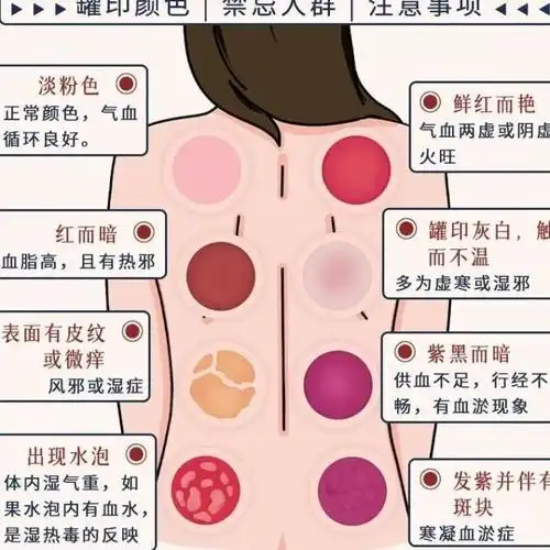 拔罐指南罐印颜色禁忌人群注意事项