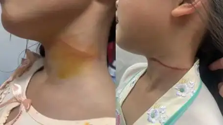 7岁女孩广场上遭风筝线割脖留长疤,妈妈后怕:无形的刀!很危险