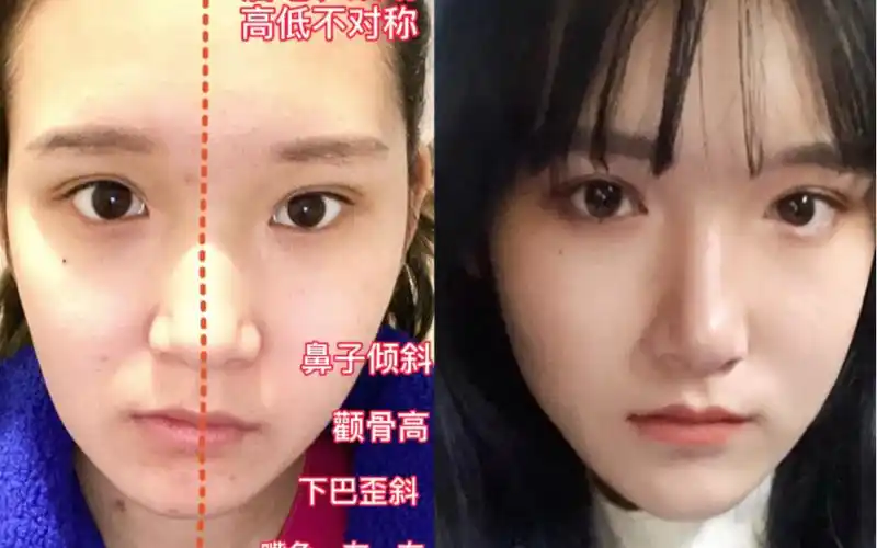 科学矫正下颌歪斜|大小脸元凶 get上镜脸_哔哩哔哩_bilibili