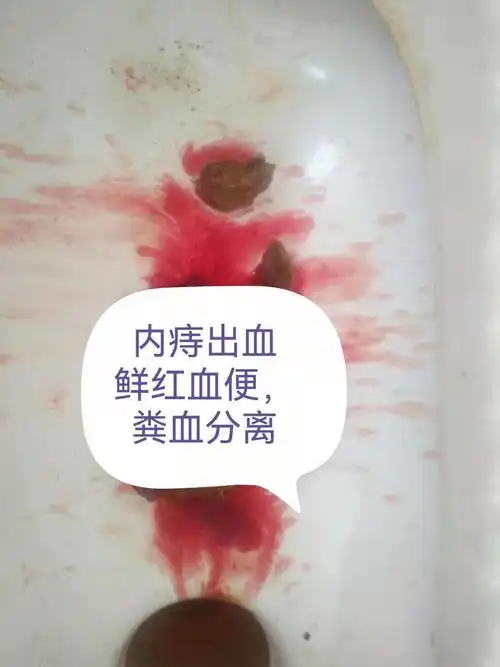 痔疮出血特点是粪血分开不相混,呈鲜红色,没有粘液脓血,没有血块,便时