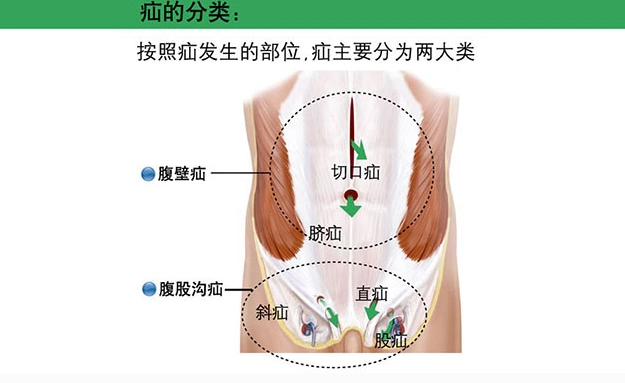 腹股沟疝图片 (7)