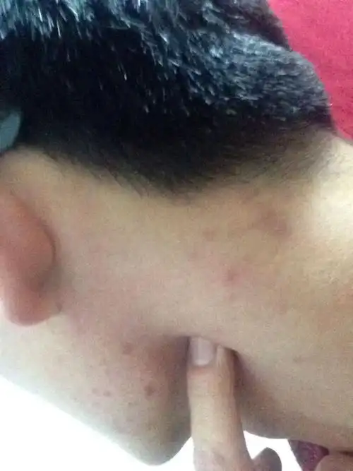 左边腮帮下面在肉里长了个痘痘,不是很大,小.