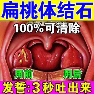 扁桃体结石去除工具扁桃体肥大肿大治口臭咽喉肿痛喉咙发炎异物感