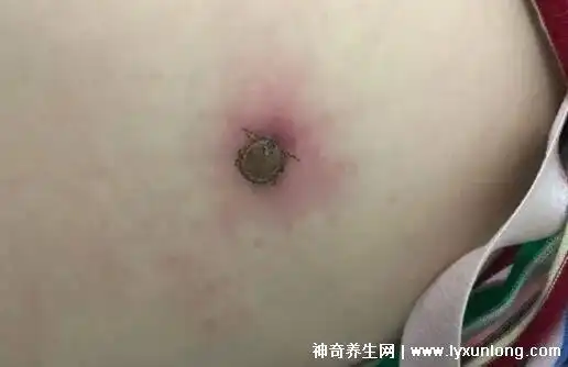 蜱虫咬人后有什么症状图片伤口有明显红肿和黑痣样严重致命