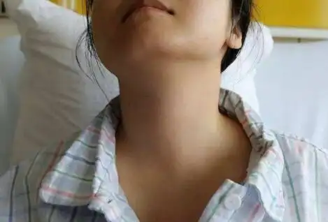 很多人认为,大脖子病是甲状腺肿大而引起的.