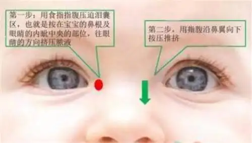 新生儿泪囊炎按摩手法图解简单实用