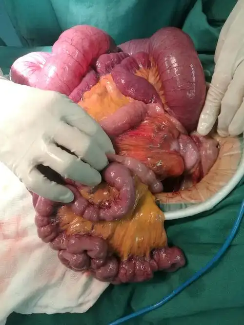 2018年12月第一台急诊开腹手术急性肠梗阻,小肠扭转致腹内疝急诊手术