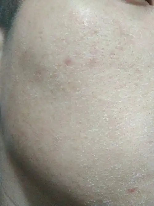 求救啊,脸上起皮,去了医院他给我开的是痤疮膏!