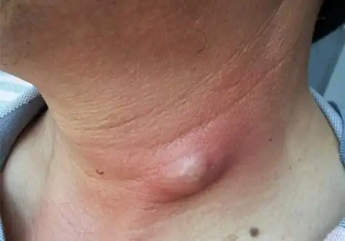 皮脂腺囊肿会自愈吗