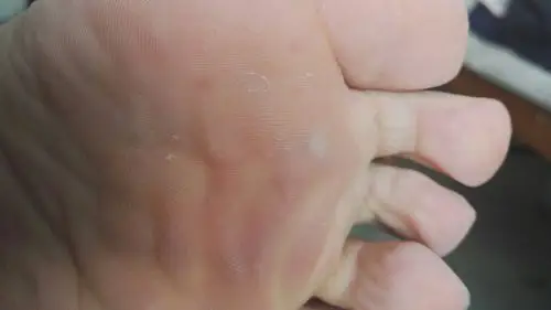 今天洗完澡发现脚底有一块发白的地方,不在表皮,而