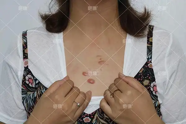 安徽陈女士前胸10年疤痕疙瘩案例