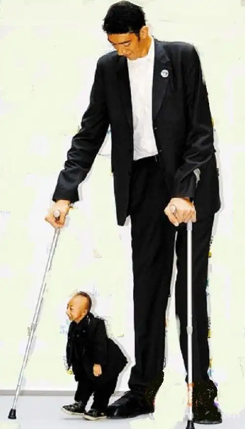 疾病图片:巨人症系腺垂体分泌生长激素(gh)过多所致.