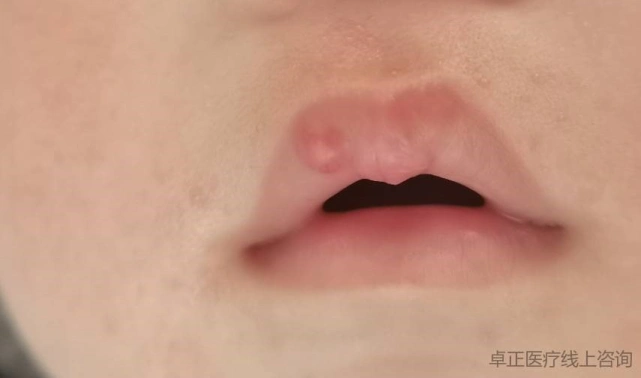 宝宝嘴唇长包1个月了还没消散是咋回事
