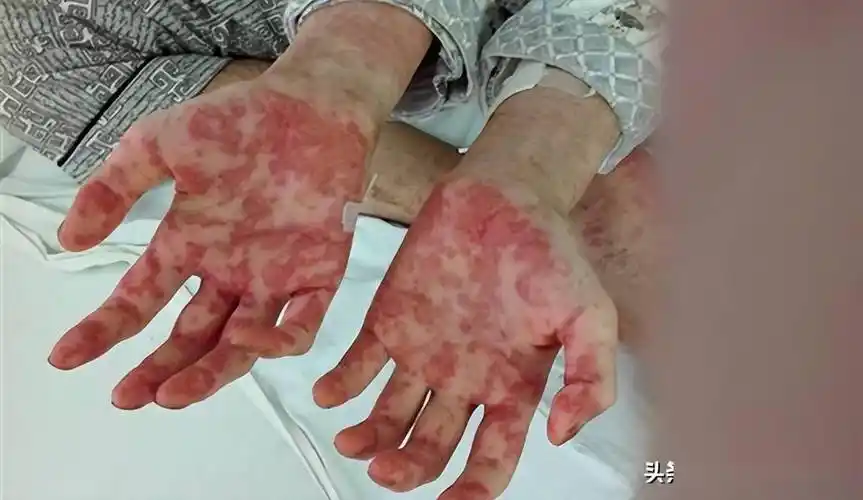 白血病多是"拖"出来的,医生:孩子有这4个反常,及时就医