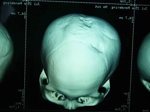 三维重建的颅骨凹陷图像