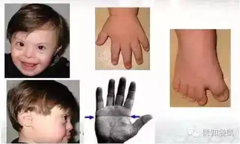 无创dna低危却生出畸形儿!避免弱智宝宝出生,最可靠的检查还是它