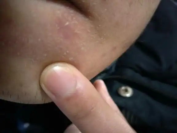 脸部起皮屑发红不知道怎么了,求问