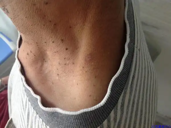 去除脖子瘊子丝状疣必治身上瘊子痦休子寻常疣去瘊灵膏不留疤特效