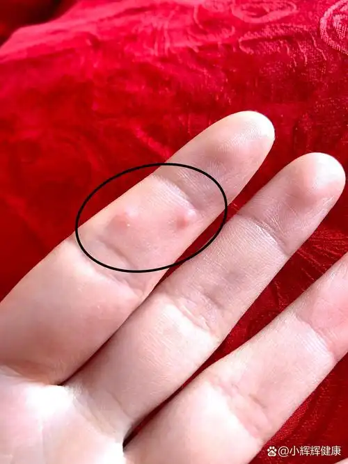 手上长的什么痘痘?