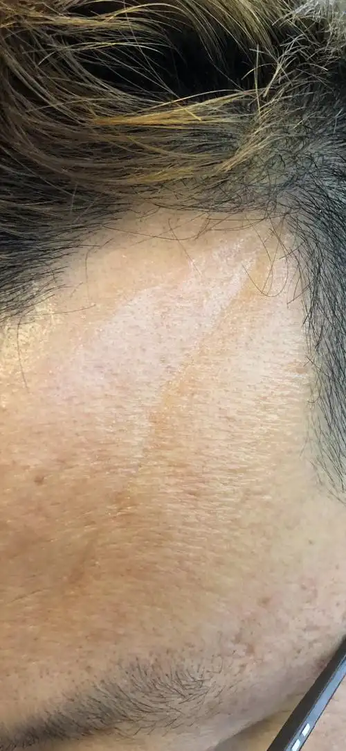 额头一旁天生有一条凹痕,请懂面相的人进入,求解!