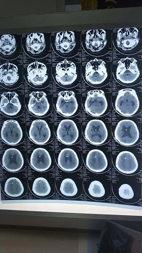 醒36--1重度车祸昏迷,5个月醒啦.