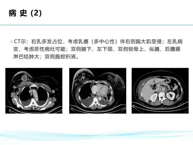 病例报告2018-2019年在美国梅奥诊所研修一年江苏省肿瘤医院优才获得