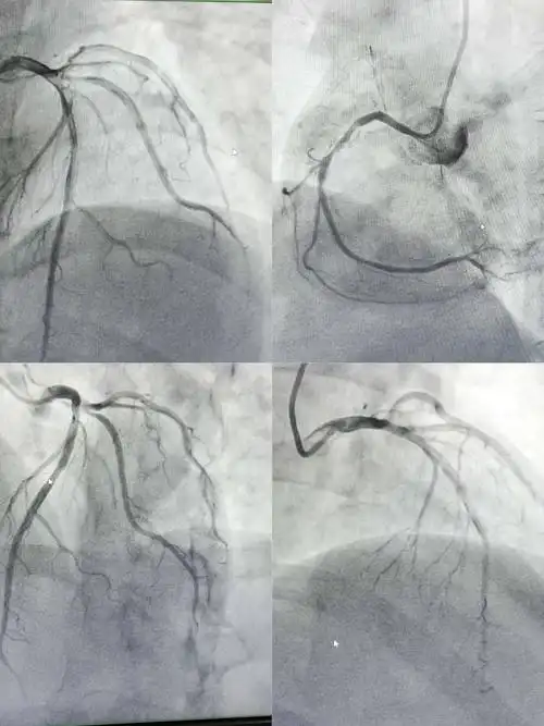 清晰的心脏冠脉造影图片!
