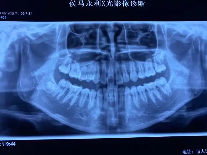 口腔全景片