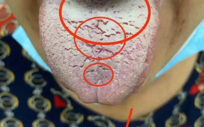 舌苔厚腻,痰湿重怎么办?