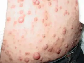 恶性神经纤维瘤大腿部位如何治疗