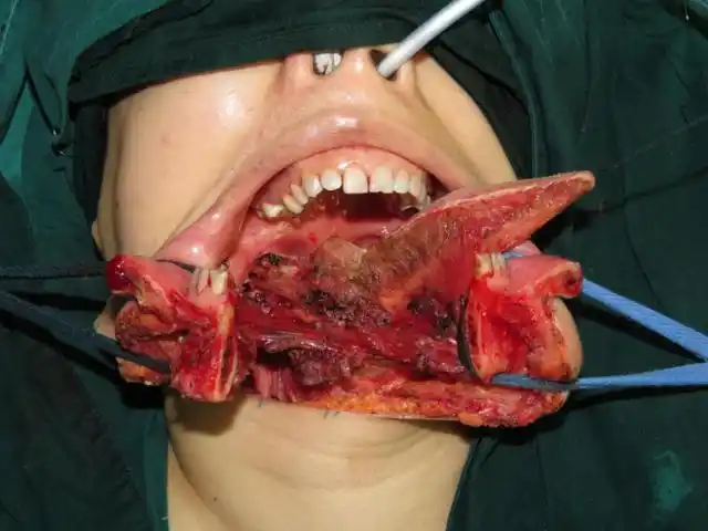 口腔癌手术后有哪些不良并发症如何处理