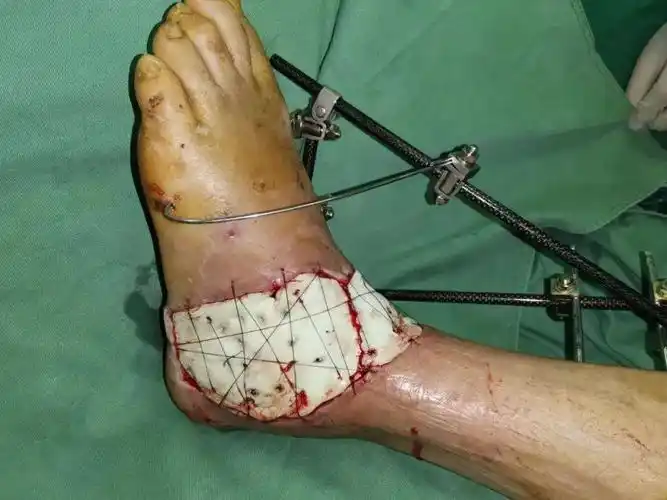 遭遇车祸左足开放性多发性粉碎性骨折术后成功保肢