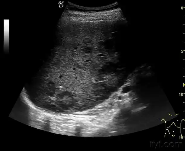 牛眼征! - 超声医学讨论版 - 爱爱医医学论坛