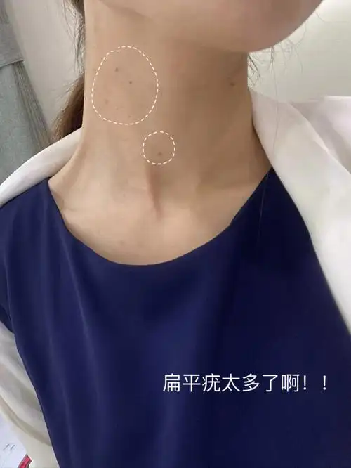 前段时间刷了好多这个帖子本来都觉得是广了,奈何看着脖子上的扁平疣