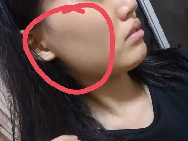 有拔智齿脸部凹陷的嘛