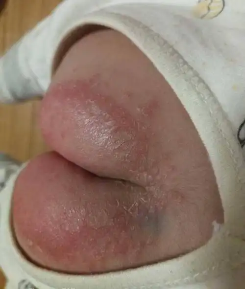 2岁女孩尿路感染入院,纸尿裤还真不是小问题!_宝宝