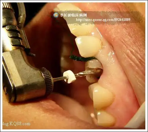 纤维桩牙齿美容性病例