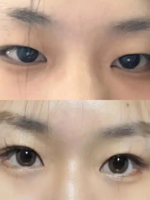 内双肿眼泡i新手必备消肿好物